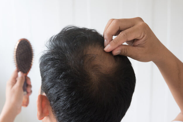 ما هو علاج تساقط الشعر عند الرجال