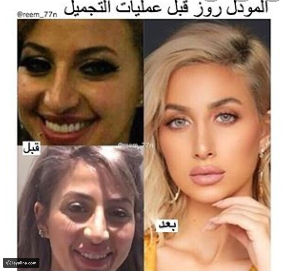شيلاء سبت قبل عمليات التجميل : ÙØ¬ÙØ§Øª Ø§ÙØ®ÙÙØ¬ ÙØ¨Ù ÙØ¨Ø¹Ø¯ Ø§ÙÙÙÙØ§Ø¬ ÙÙØµÙØ§Øª Ø§ÙØ´Ø¹Ø± ÙØ¬ÙØ© Ø§ÙØ¬ÙÙÙØ© : For more information and source,.