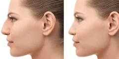 تجربتي مع عملية تجميل الأنف بالليزر؟