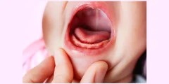 علامات التسنين بالصور وعلامات لثة الرضيع عند التسنين؟
