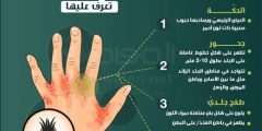 أقوى علاج للجرب سريع المفعول