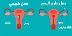 أسباب وأعراض الحمل خارج الرحم
