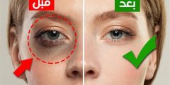 أسباب وطرق علاج السواد تحت العين