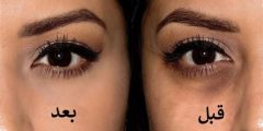 أسرع علاج للهالات السوداء تحت العين مجرب 2025