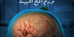 اسباب سرطان المخ واعراضه وتشخيصه