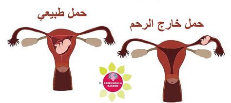 تأثير أكياس الماء في الرحم على فرص الحمل تأثير أكياس الماء في الرحم على فرص الحمل